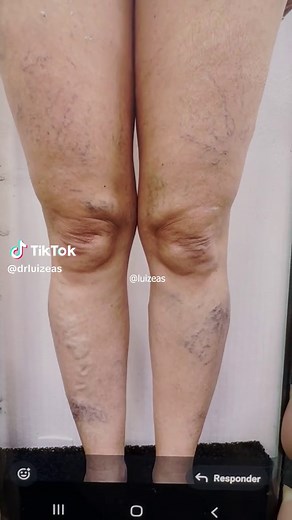 Tratamento Satisfatório de Varizes e Vasinhos