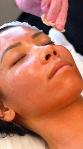 Micro Needling PRP With Diluted Cocktail. Give your skin a clear & glowing experince. #PRP# Skin# Prairie Beauty House# Microneedling# Connect wtih us @ 9958067276 | Prairie Essentials