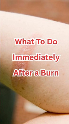 What To Do Immediately After a Burn