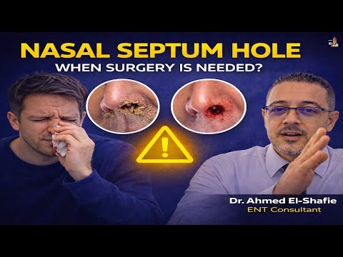 ⭐When Do You Need Surgery for a Deviated Septum? Symptoms, Causes & Treatment
