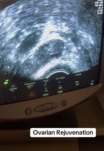 Ovarian Rejuvenation Procedure Explained