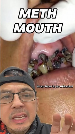 How Meth Mouth (Drug Abuse) Affects Oral Health | In Office to Hands On Dental Training #shorts