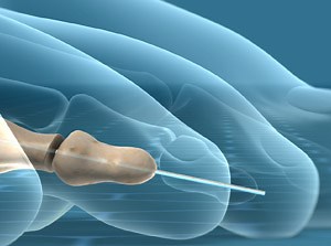 Mallet Toe Correction (DIP Joint Arthroplasty)