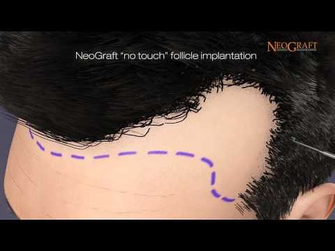 NeoGraft Hair Transplant Demo Video