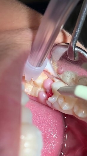 Growth of Gums: Causes and Solutions