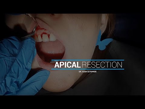 Apikal Rezeksiyon | Dr. Kaan Öztoprak