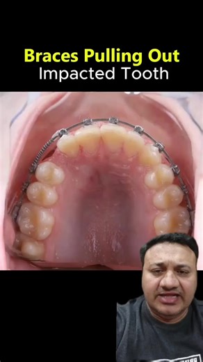 Understanding Canine Impaction and Dental Care