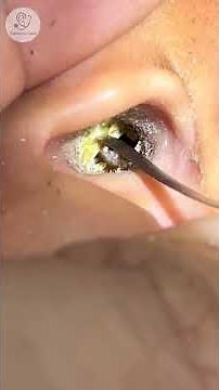 Satisfying Ear Wax Removal | Deep Ear Cleaning with Calm Music