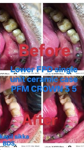 LOWER FPD SINGLE UNIT CERAMIC CASE PFM CROWN VERMA DENTAL CARE BRIGHT SMILE DR KAPIL SIKKA BDS 🦷