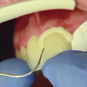 3M™ RelyX Universal. Excess Cleanup Video