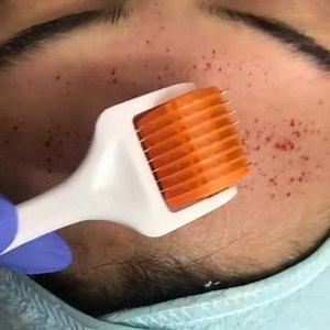 Acne problems? Clogged or enlarged pores? We’ve got you covered! While a derma roller may look like some kind of a torture device, it’s actually quite helpful and not painful at all when used properly.There are a plethora of benefits. Clogged and enlarged pores are not only unattractive, they can lead to great problems such as an increasingly acne-damaged layer of skin, blackheads, oily skin, and more. Often located on the nose and around the cheeks, derma rolling can help to reduce the size of 