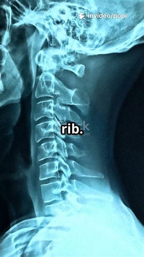 Some People Have an Extra Rib! 🦴 #HumanBody #WeirdFacts #Science