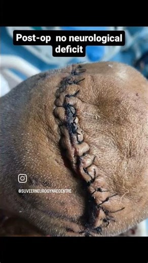 Complete excision of large brain tumor without any Neurological deficit 🙏