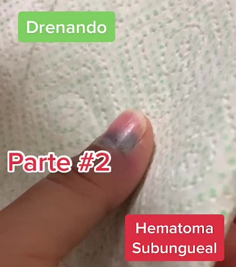 Drenaje de Hematoma Subungueal: Parte 2