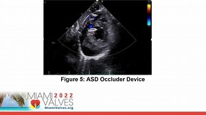 Transcatheter Occluder Device Closure of Post-myocardial Infarct Ventricular Septal Defect: A Case Series