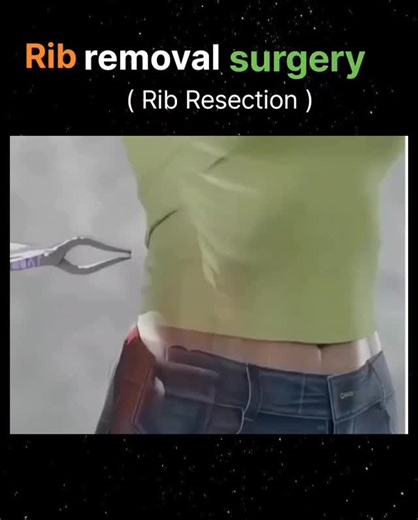 Biology World on Instagram: "Rib removal surgery, or rib resection, is the surgical removal of a portion of a rib to treat medical conditions like thoracic outlet syndrome (TOS) or to improve surgical exposure in chest procedures. A first rib resection specifically targets the rib beneath the collarbone to relieve nerve or blood vessel compression, often through a transaxillary (underarm) or supraclavicular (above the collarbone) incision. Recovery involves managing pain, restricted activity for