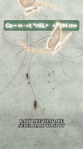 Lice Are Not All the Same Size and This Is Exactly Why One Treatment Never Works #shorts