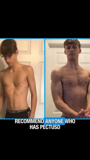 INSANE Pectus Excavatum Transformation from Exercise