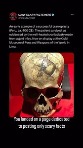 The cranioplasty from Peru, dating to around 400 CE, is a notable example of ancient surgical skill. This early surgical procedure involved the implantation of a gold inlay into the skull, a technique used to repair skull fractures or deformities. The patient, whose skull was found with the gold inlay, survived the operation, as evidenced by the well-healed condition of the cranioplasty. The gold inlay was carefully crafted and fitted into the skull, showcasing the high level of precision and cr