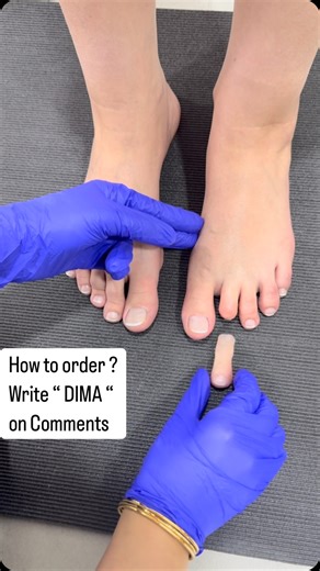 Ismaeil Mohamed on Instagram: "Custom Silicone Prosthetics: Crafting Realistic Solutions for Limb Loss” Description: Discover how custom silicone prosthetics are designed and manufactured to restore both function and appearance for individuals with limb loss. This video walks you through the full process—from initial consultation and registration to color matching, shaping, and final delivery. Learn about the benefits of silicone prosthetics, how they replicate natural anatomy, and what to expec