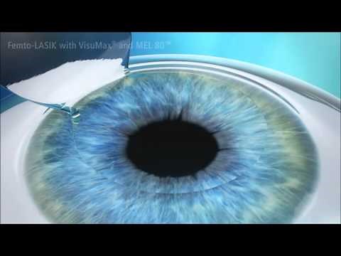 Femto LASIK