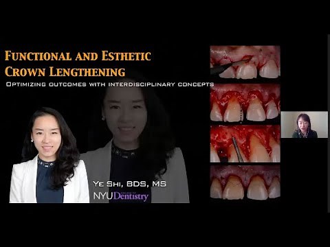 Esthetic Crown Lengthening By Dr Ye Shi