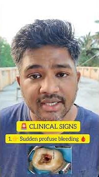 Perforation During Root Canal 😱 | Causes, Signs & MTA Repair Explained #trending #reels