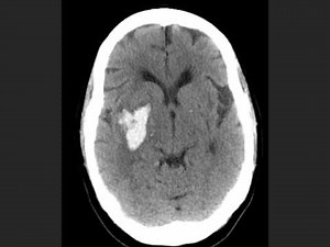 CT windows, levels and densities SHORT VERSION