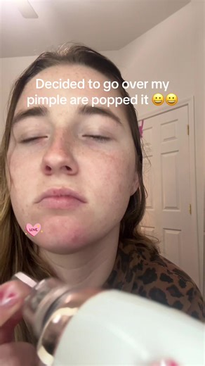 Since tik tok said it was “disturbing” I’ll post it again and cover it #fypシ゚viral #pimplepopping #acne #disgustingsatisfaction