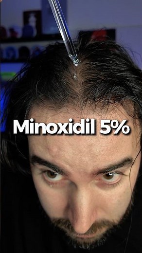 Stop Hair Loss Fast 🚫 My Minoxidil 5% + Rosemary Oil Routine for Real Hair Regrowth 💆🏻‍♂️💧💊🌱