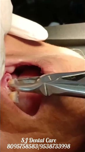 painless multiple tooth removal..sj dental care