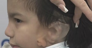 Surgeon creates new ear for boy using cadaver tissue