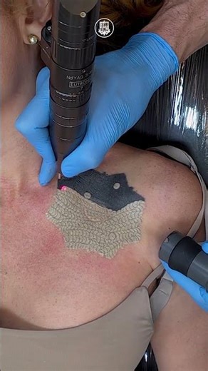 Início da remoção de tatuagem extremamente pigmentada no colo | Remoção de Tatuagem