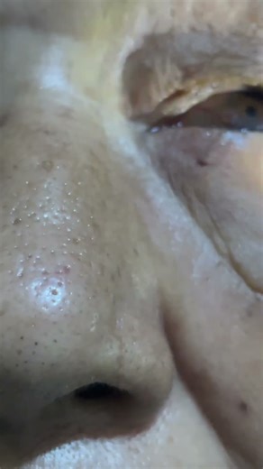 RAPD.Relative Afferent Pupillary Defect #ophthalmology #eyes #optometry #ophthalmo #viral #shorts