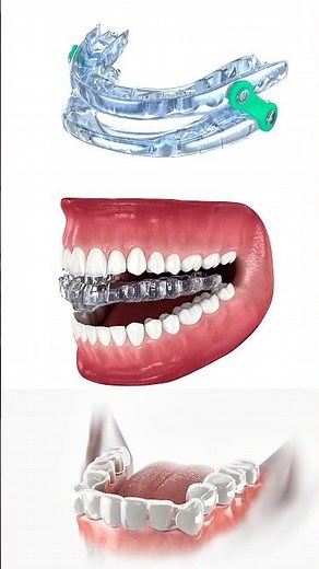 #dentist Clear aligner fitting — step by step. Precision tooth movement. #invisalignday #invisalign