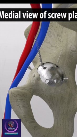 Revision hip replacement #reels | Medical Animation Media