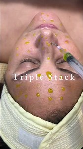 AeROLASE Neo x BioRePeel x Hydrafacial triple stack #skincare #aerolase #biorepeel #hydrafacial