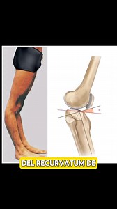 Genu-recurvatum | Lic.Luis Chicaiza DC.
