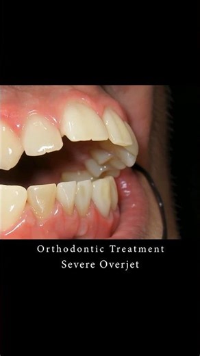 Extractions of Teeth in #orthodontics! Buck teeth! #braces #orthodontist #dentist