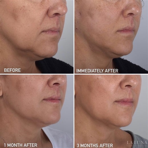 Thread Lift Experts on Instagram: "The Thread Lift Stages 1. Immediately after the skin is tight with some swelling 2. At one month the tension decreases slightly and the threads settle into position 3. At 3 months the collagen has been stimulated and the skin gets tighter and firmer. At this point as new collagen is produced the skin texture improves and gives a radiant glow - Thread Lift Information ▫️non surgical treatment ▫️barbed dissolvable PDO threads lift skin ▫️mechanism: threads dissol
