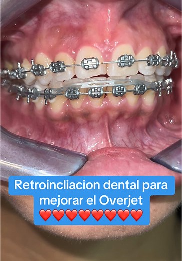 Retro inclinación dental: Mejora tu Overjet hoy