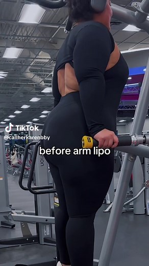 Transformation through upper body lipo: Before and After Results 🌸