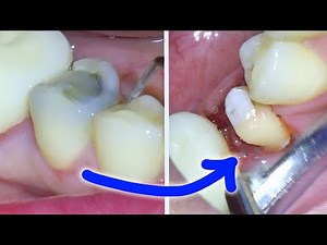 Full Dental Crown Procedure - After a Root Canal On a Molar • Video • MEDtube.net