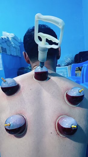 Benefits of Cupping Therapy Explained
