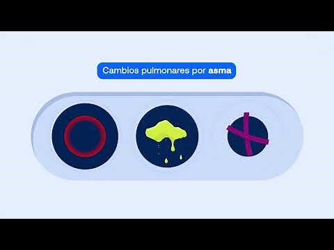 Qué es el asma?