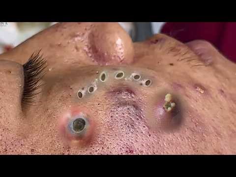 Acne, Zit & Pimple Removal | Blackhead Extraction | Abscess Drainage | Cyst Popping this week #14