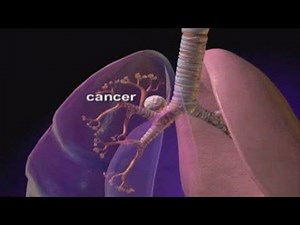 53K views · 1.7K shares | Cancer du poumon | Encyclopédie Médicale | Facebook
