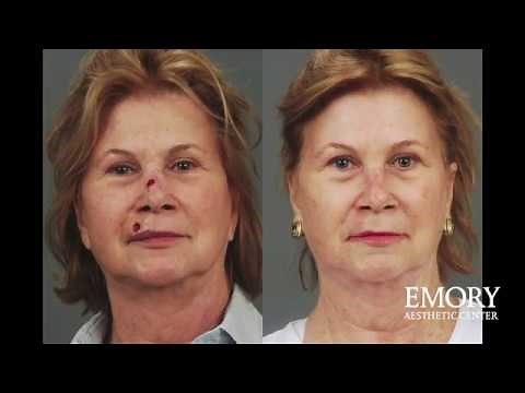 Mohs Closure Surgery At The Emory Aesthetic Center