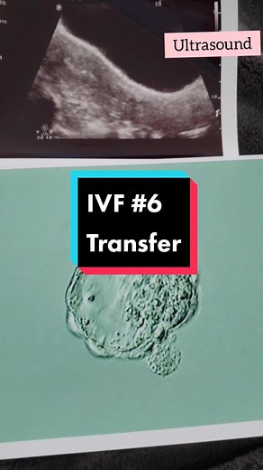 anyone transferred fully hatched embryo?? #ivf #6 #ivftransfer #fet #ivfbaby #ivfwarrior #ivfjourney #infertility #infertilityjourney