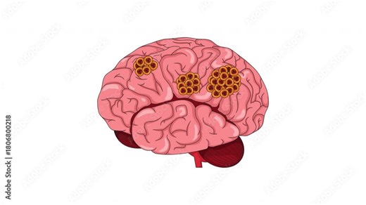 Human brain with cancerous tumors growing cartoon animation. Cancer cells appearing on cerebral organ. Malignant pathology. Oncology education animated flat 2D object 4K video isolated on white